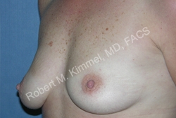 Breast Asymmetry Correction Patient 30681 Photo 1