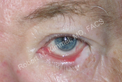 Eyelid Reconstruction Patient 31515 Photo 1