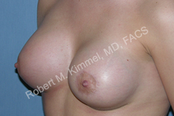 Breast Asymmetry Correction Patient 77858 Photo 2