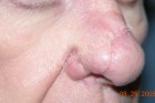 Skin Cancer Removal Patient 13660 Photo 2
