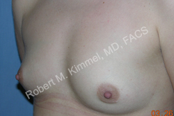Breast Augmentation Patient 72992 Photo 1