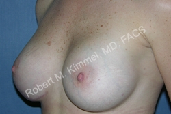 Breast Asymmetry Correction Patient 30681 Photo 2