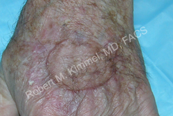 Skin Cancer Removal Patient 34131 Photo 2