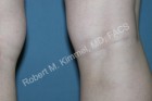 Injection Sclerotherapy Patient 80754 Photo 2
