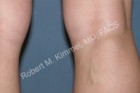 Injection Sclerotherapy Patient 80754 Photo 1