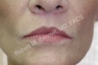 Lip Augmentation Patient 88639 Photo 2