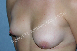 Breast Asymmetry Correction Patient 77858 Photo 1