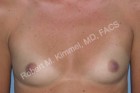 Breast Augmentation Patient 99956 Photo 1