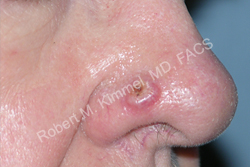 Skin Cancer Removal Patient 13660 Photo 1
