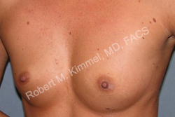 Breast Augmentation Patient 97213 Photo 1