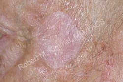 Skin Cancer Removal Patient 51387 Photo 2