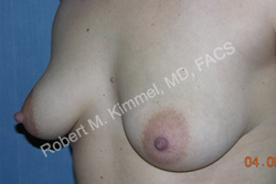Breast Augmentation Patient 94176 Photo 1