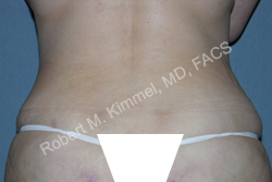Liposuction Patient 79065 Photo 2
