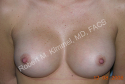 Breast Augmentation Patient 99956 Photo 2