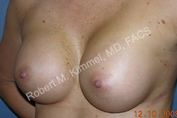 Breast Augmentation Patient 97213 Photo 2