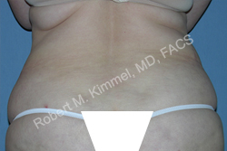 Liposuction Patient 79065 Photo 1