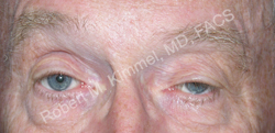 Eyelid Reconstruction Patient 68590 Photo 1
