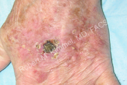 Skin Cancer Removal Patient 34131 Photo 1