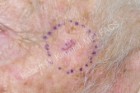 Skin Cancer Removal Patient 51387 Photo 1