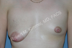 Breast Asymmetry Correction Patient 92909 Photo 1