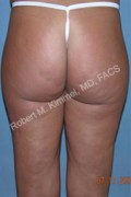 Liposuction Patient 96081 Photo 1