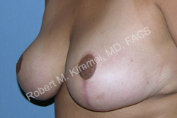 Breast Reduction Patient 11748 Photo 2