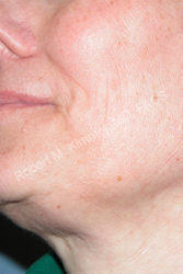 Face Procedures Patient 10212 Photo 1
