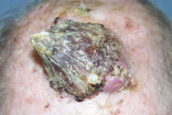 Skin Cancer Removal Patient 84539 Photo 1