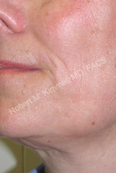 Face Procedures Patient 10212 Photo 2