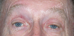Eyelid Reconstruction Patient 68590 Photo 2