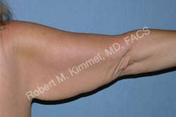 Arm Lift (Brachioplasty) Patient 71202 Photo 1