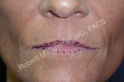 Lip Augmentation Patient 88639 Photo 1