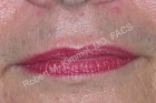 Laser Hair Removal Patient 33234 Photo 1