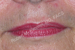 Laser Hair Removal Patient 33234 Photo 1