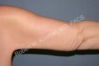 Arm Lift (Brachioplasty) Patient 71202 Photo 2