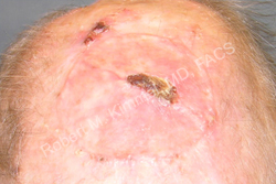 Skin Cancer Removal Patient 84539 Photo 2