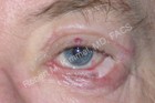 Eyelid Reconstruction Patient 31515 Photo 2