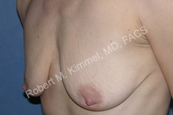 Breast Augmentation Patient 22169 Photo 1