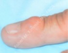 Cyst Removal Patient 42382 Photo 1
