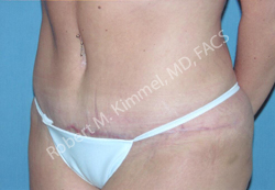 Abdominoplasty Patient 97022 Photo 2