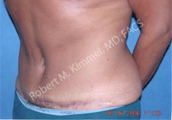 Male Abdominoplasty Patient 98207 Photo 2