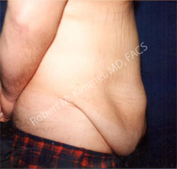 Male Abdominoplasty Patient 54859 Photo 1