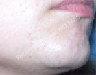 Laser Hair Removal Patient 43923 Photo 1