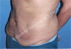Male Abdominoplasty Patient 98207 Photo 1