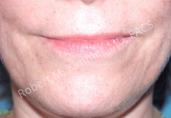 Lip Lift Patient 89916 Photo 1