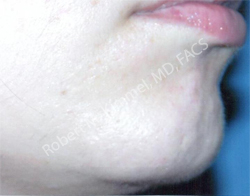 Laser Hair Removal Patient 43923 Photo 2