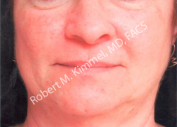 Autologus Fat or Stem Cell Makeovers Patient 24080 Photo 1