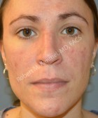 Acne Treatment Patient 92772 Photo 2