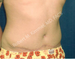 Male Abdominoplasty Patient 91334 Photo 2