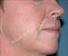 Thermage CPT® Patient 32828 Photo 1
